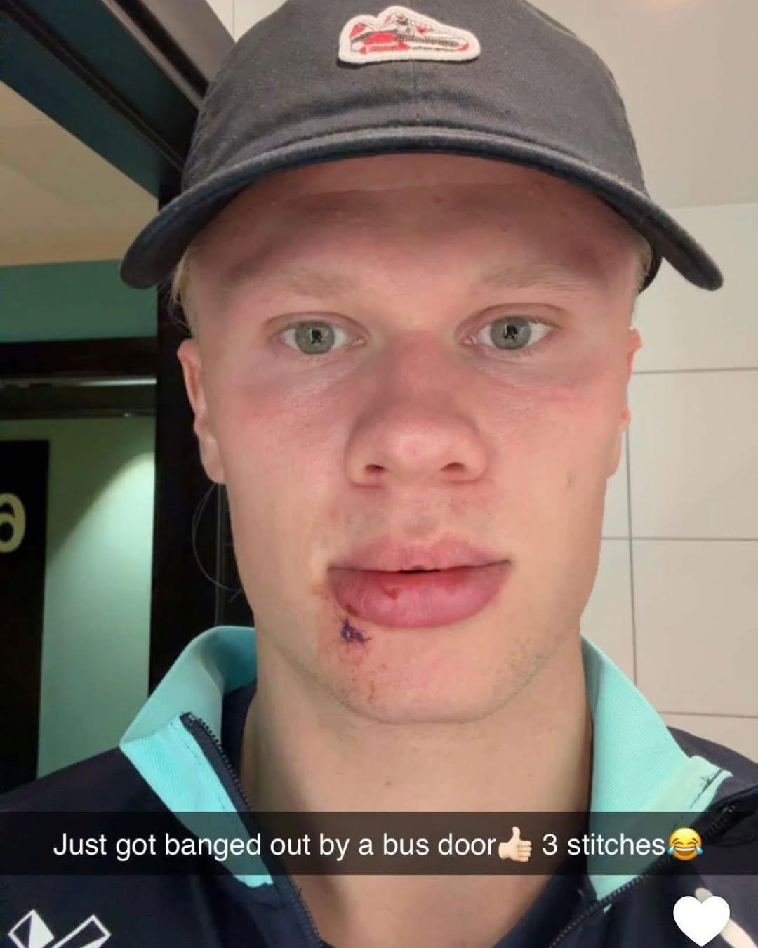 Erling Haaland bị thương ở mặt