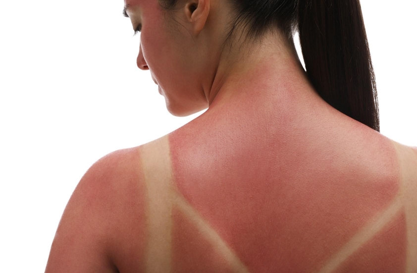 5 Chơi pickleball lâu ngoài trời có thể khiến da đen sạm, nám và lão hóa sớm