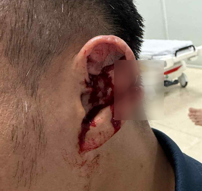 Trọng Hoàng đi khâu tai sau trận đấu Trọng Hoàng đi khâu tai sau trận đấu